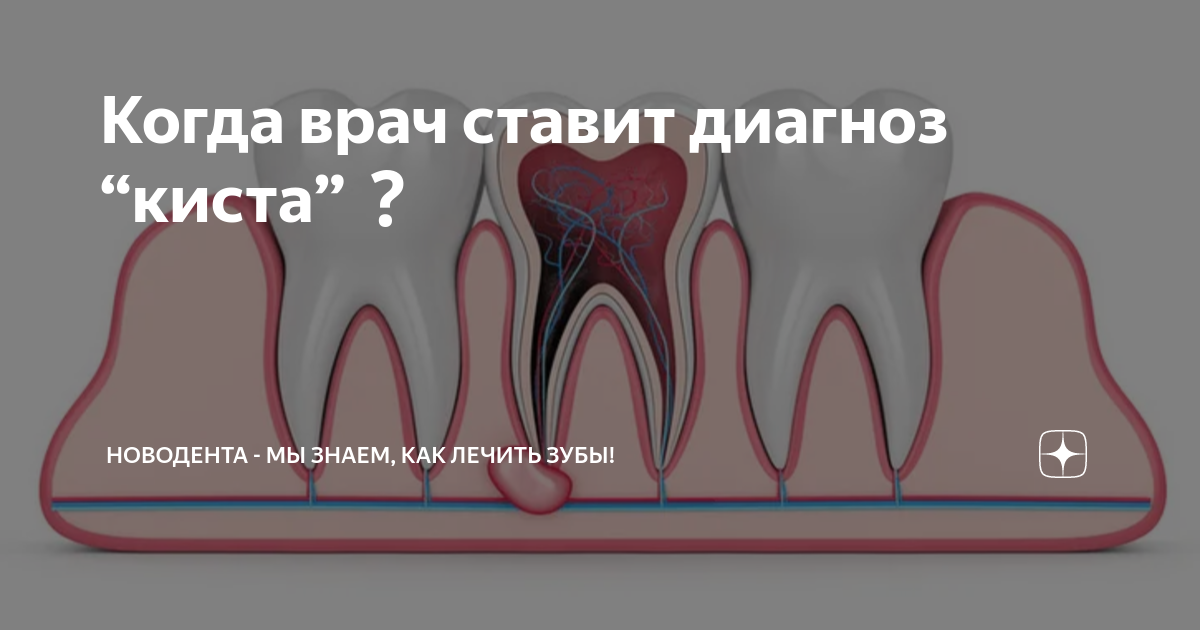 Когда врач ставит диагноз “киста” | НОВОДЕНТА - Мы знаем, как лечить ...