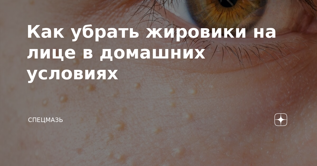 Как избавиться от жировиков под кожей? Нужно ли удалять подкожные жировики?