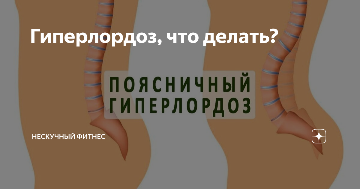 Гиперлордоз, что делать? | Нескучный фитнес | Дзен