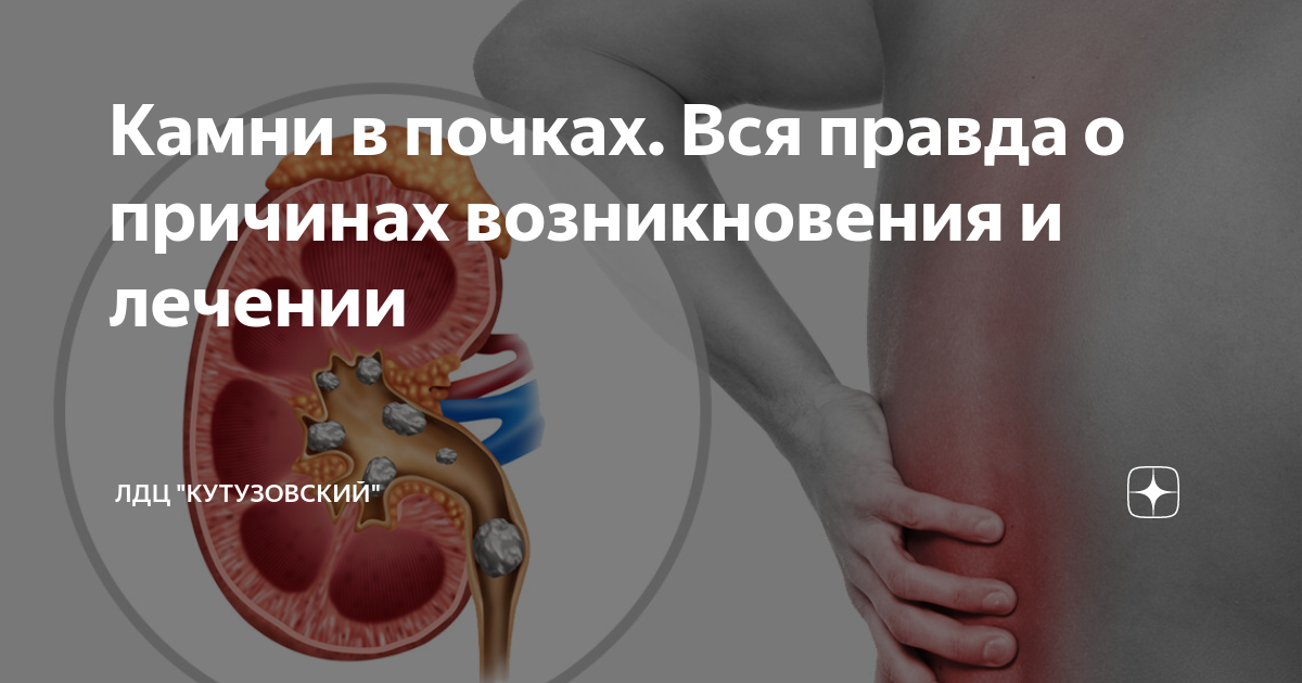 Камни в почках у женщин причина появления. Причины появления камней в почках. Симптомы воспаления камней в почках.
