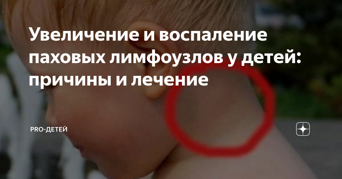 Как выглядит лимфоузел у детей Инфекционный мононуклеоз презентация онлайн
