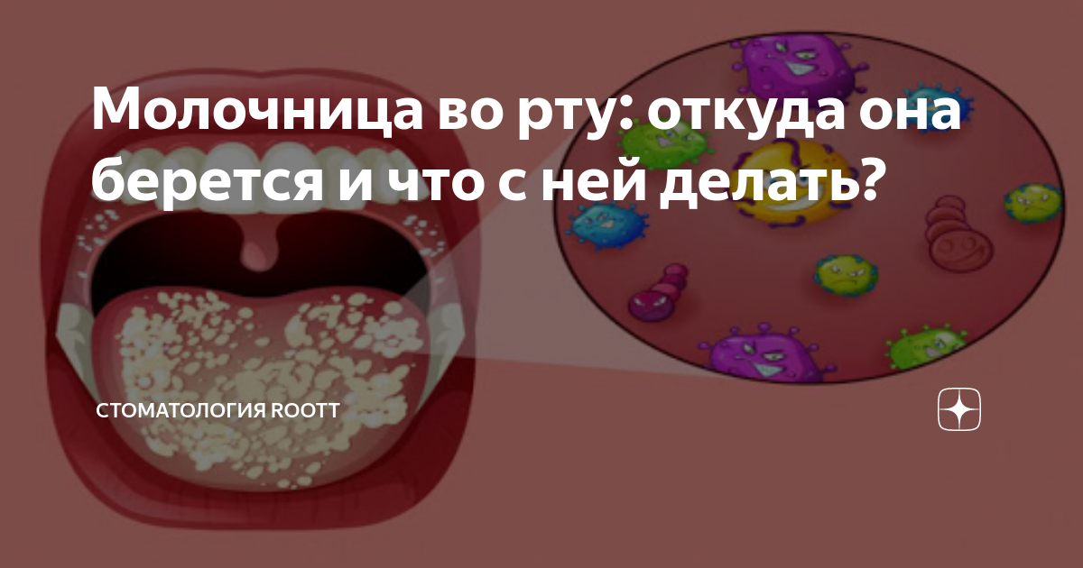 Молочница во рту, кандидозный стоматит полости рта: что это такое, симптомы и лечение