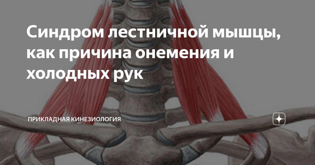 Синдром лестничной мышцы Синдром лестничной мышцы