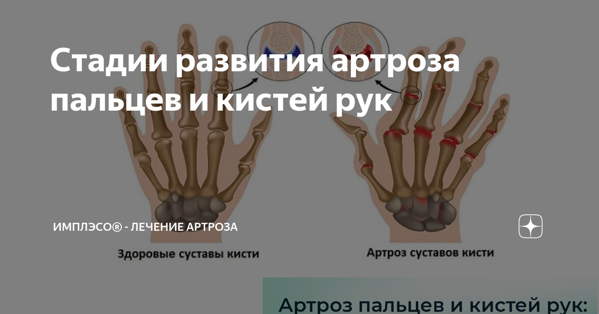 Фото подборка АРТРОЗЫ СУСТАВОВ СТЕПЕНИ
