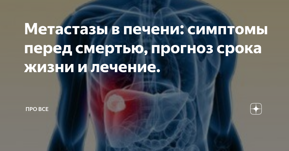 Лечение метастазов народными средствами. Метастаз в печени без первичного очага. Метастазы в печени симптомы. Метастазы печени без первичного очага симптомы. Новое в лечении метастаз.