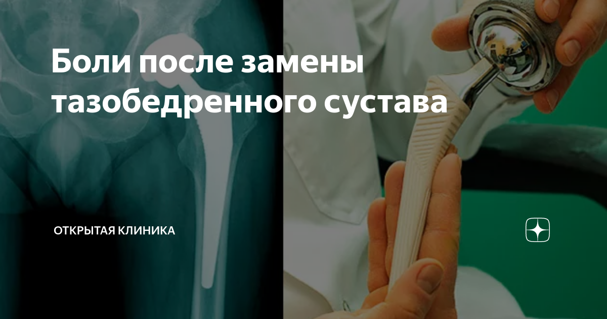 После замены тазобедренного