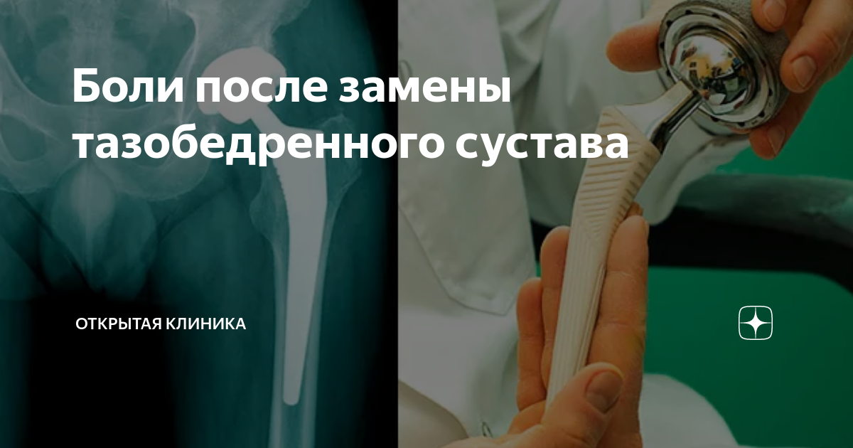 Операция по замене тазобедренного сустава. Брошюра для пациентов с эндопротезированием тазобедренного сустава. После замены тазобедренного сустава. Протезирование тазобедренного сустава.