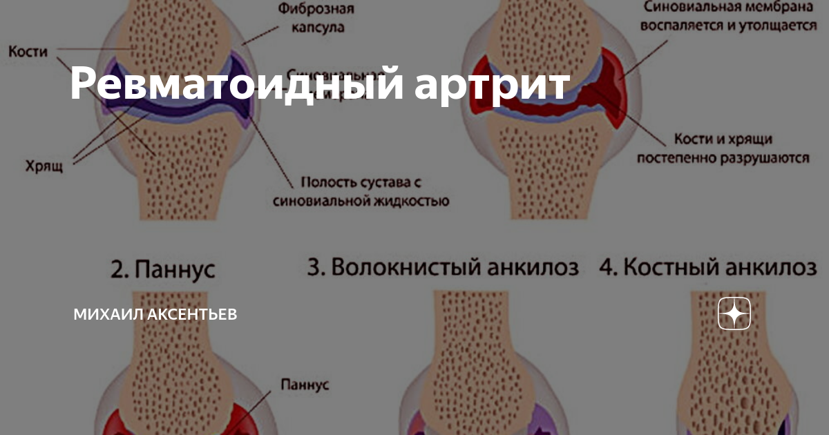 Ревматоидный артрит. Патогенез, клиническая картина, диагностика