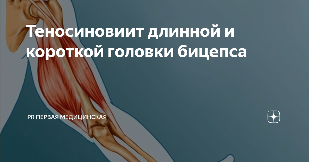 Теносиновиит длинной и короткой головки бицепса | Первая Медицинская ...