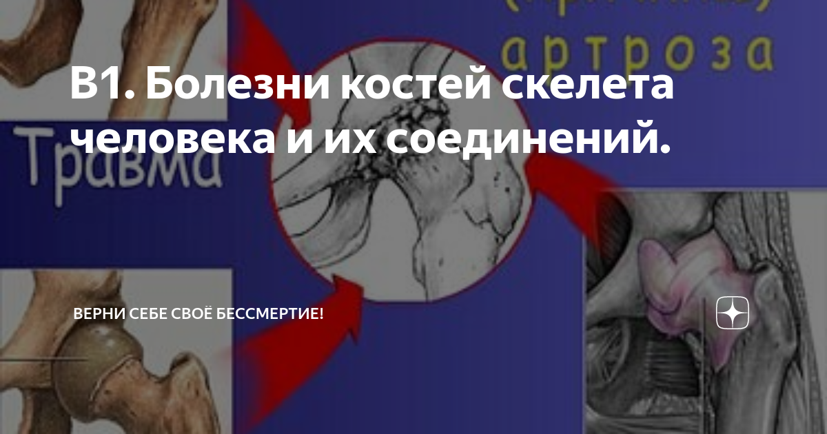 В1. Болезни костей скелета человека и их соединений. | Верни себе своё  бессмертие! | Дзен