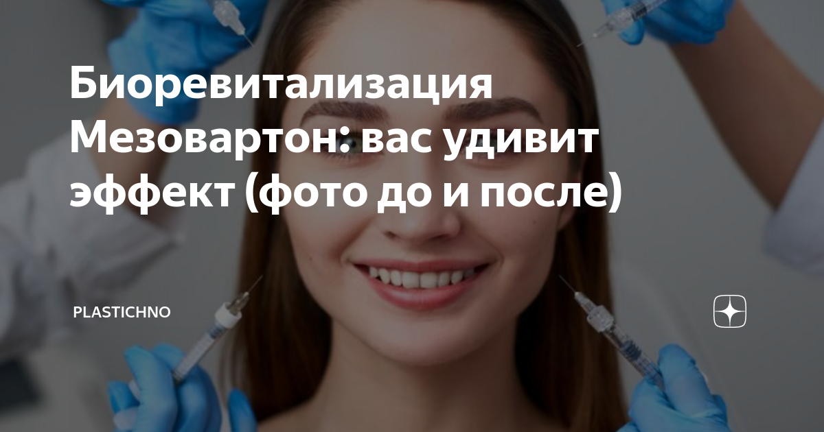 Мезовартон отзывы клиентов фото до и после