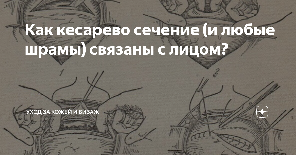Натальная карта при кесаревом сечении