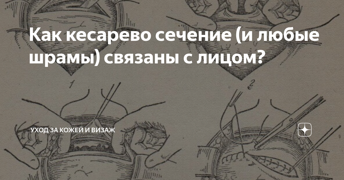 Поперечный разрез кесарево. Кесарево сечение схема. Кесарево сечение схема операции.