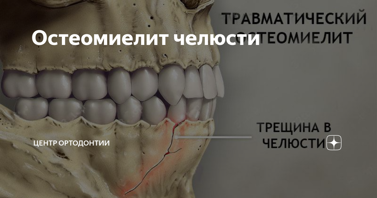 Остеомиелит челюсти - причины, симптомы, диагностика