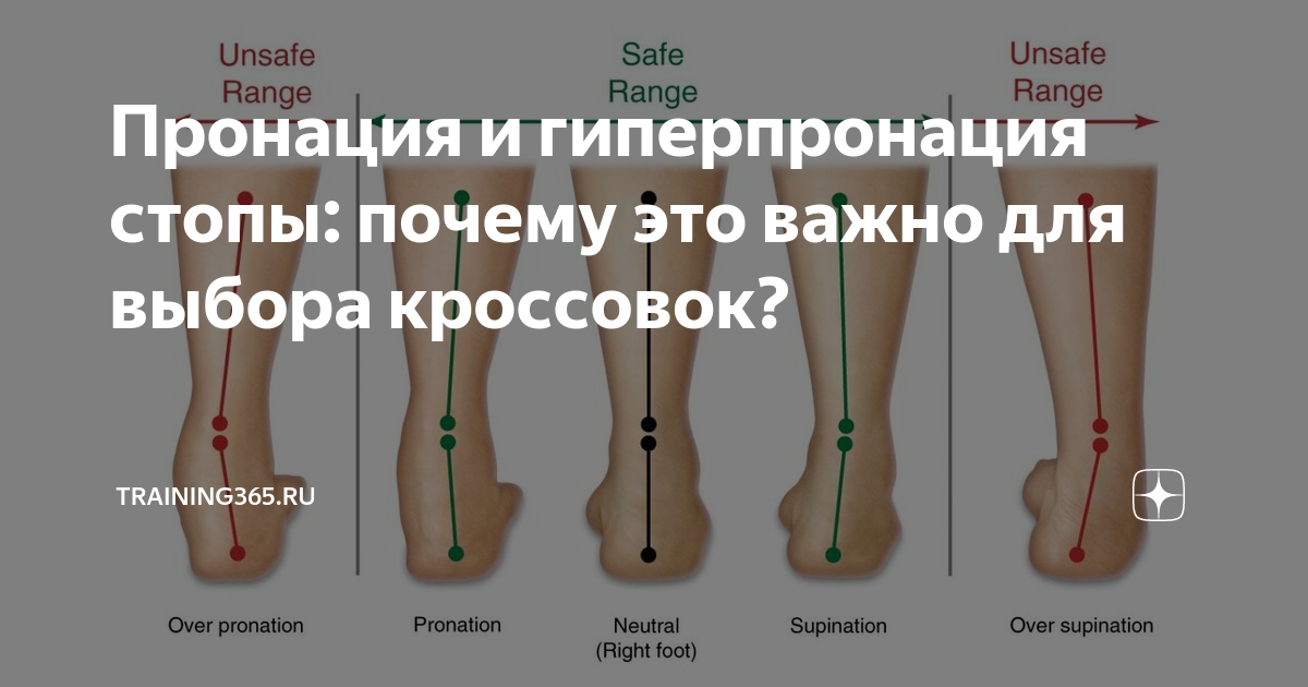 Пронация стопы. Гиперпронация. Вальгусная пронация стопы. Излишняя пронация стопы. Причины пронации стопы.