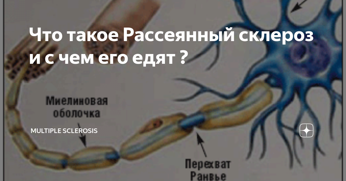 Передается ли рассеянный склероз по наследству