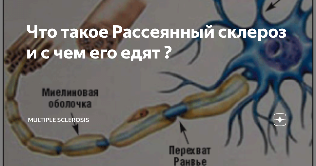 Для клинической картины рассеянного склероза не характерно