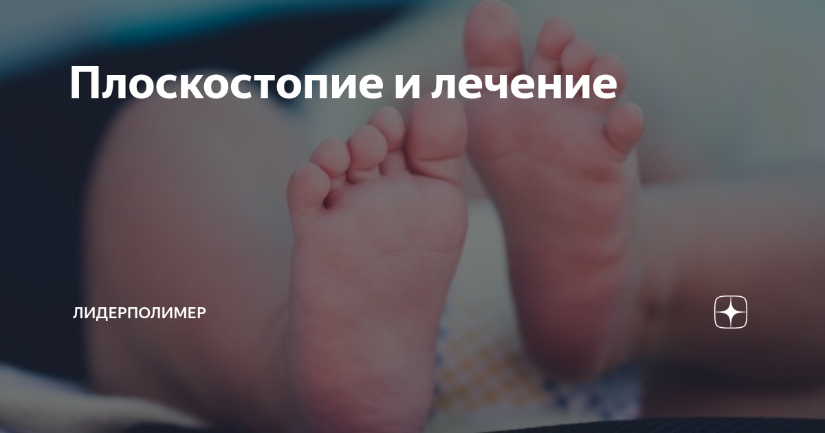 Плоскостопие у детей, тест, профилактика, упражнения