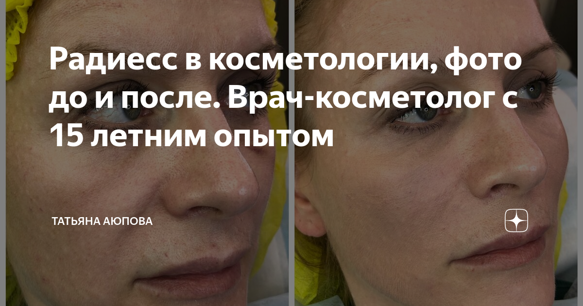 Radiesse отзывы фото до и после цена Радиесс в косметологии, фото до и после. Врач-косметолог с 15 летним опытом Тать