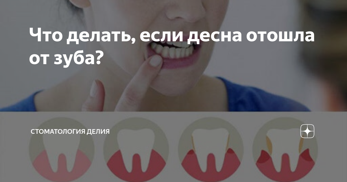 ВЫБИЛ ЗУБ - что делать? Информация для пациентов.