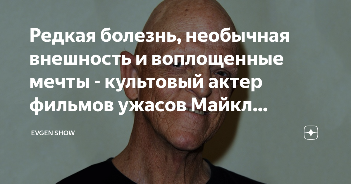 Редкая болезнь, необычная внешность и воплощенные мечты - культовый ...