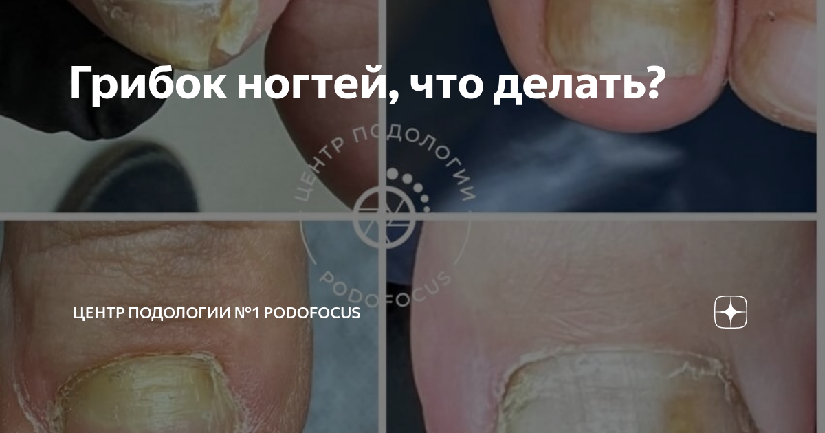 Грибок ногтей, что делать? | Центр подологии №1 PodoFocus | Дзен