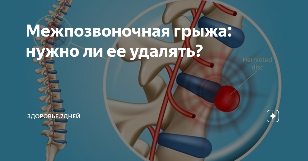 остеохондроз пояснично-крестцового отдела мкб 10. межпозвоночная грыжа код. межпозвоночная грыжа. межпозвоночная грыжа код. межпозвоночная грыжа.