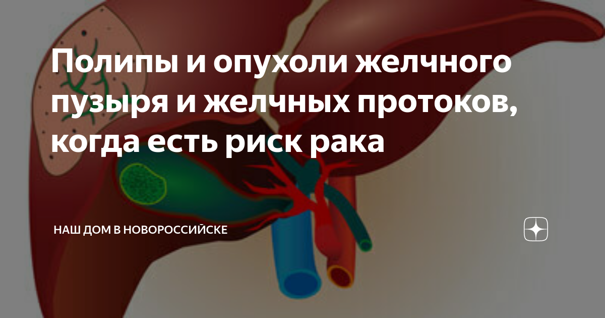 Народное лечение полипа в желчном пузыре. Полипоз желчного пузыря. Полипоз желчного пузыря гистология. Злокачественные новообразования желчного пузыря.