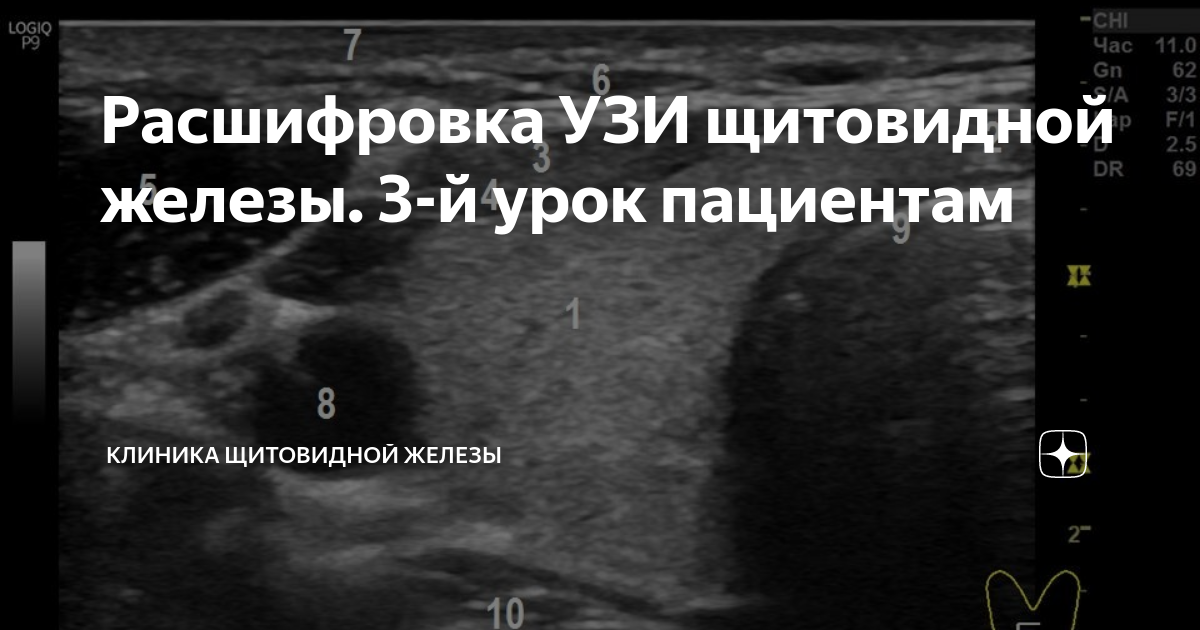 Узи щитовидной подготовка. УЗИ щитовидной железы Изранов. УЗИ неровные контуры щитовидной железы. УЗИ щитовидной железы у женщин. УЗИ щитовидной железы подготовка.