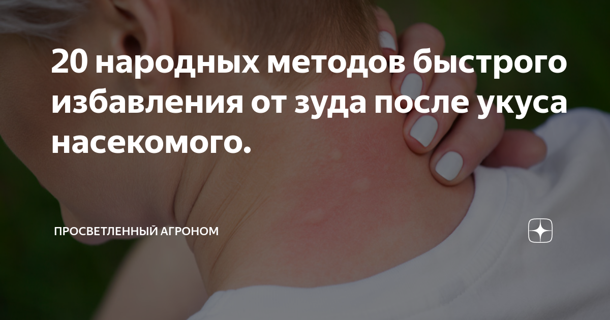20 народных методов быстрого избавления от зуда после укуса насекомого ...