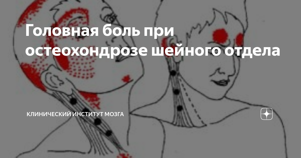 Повысить давление при шейном остеохондрозе. Головная боль при остеохондрозе шейного отдела. может ли болеть голова от шейного остеохондроза. боль в горле от шейного остеохондроза. шейный остеохондроз и головная боль лечение.