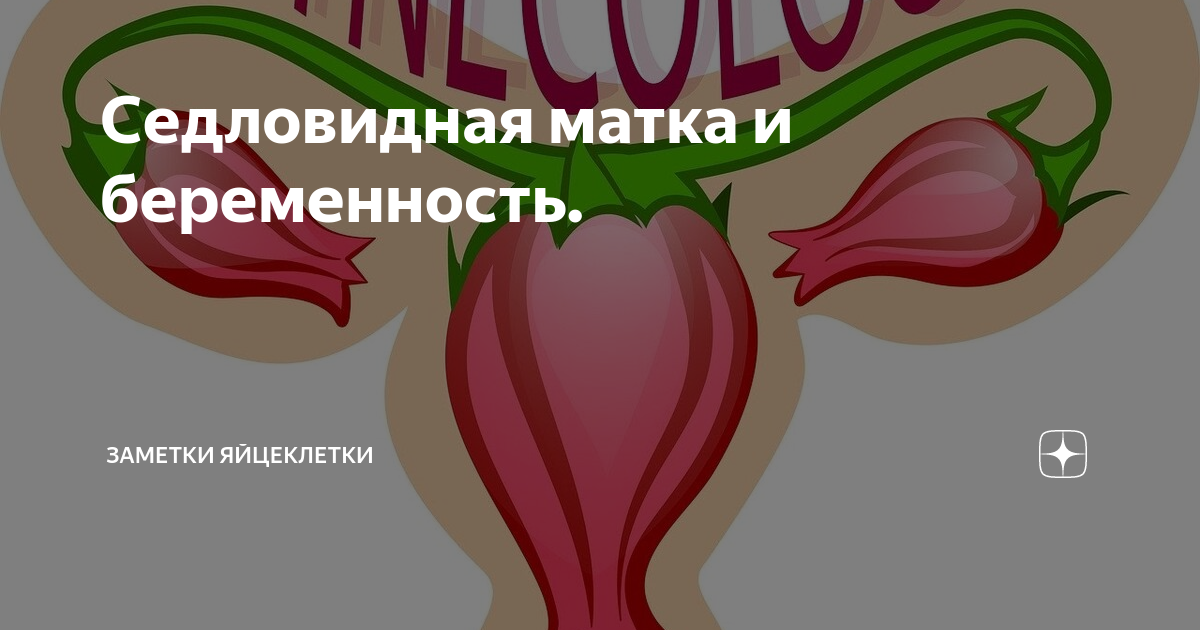 Седловидная матка это. Седловидная матка и беременность. Матка седловидной формы. Седловидная опора. Матка размерами до 55 49 57 мм седловидная.