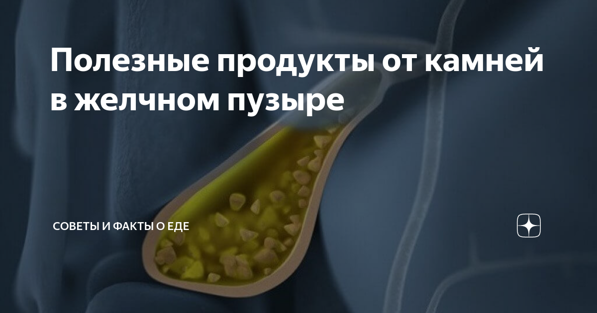 Что пить при камнях в желчном. Полезные продукты от камней в желчном пузыре. Диета при желчекаменной болезни и камнях в желчном. ЖКБ диета.