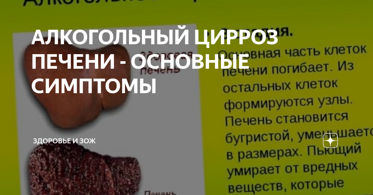 Диф диагностика цирроза печени. Циррозная печень алкоголика. Печень гистология портальный цирроз. Размер печени у алкоголиков. Печень и алкоголь заболевания.