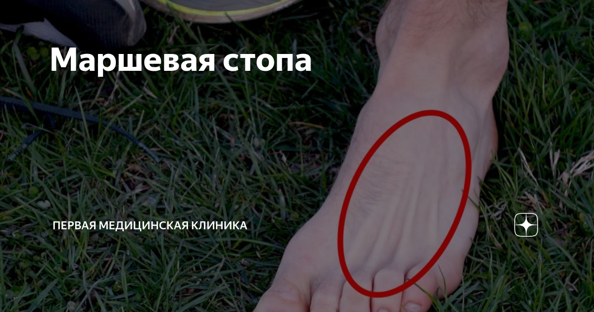 Маршевая стопа | Первая Медицинская Клиника | Дзен