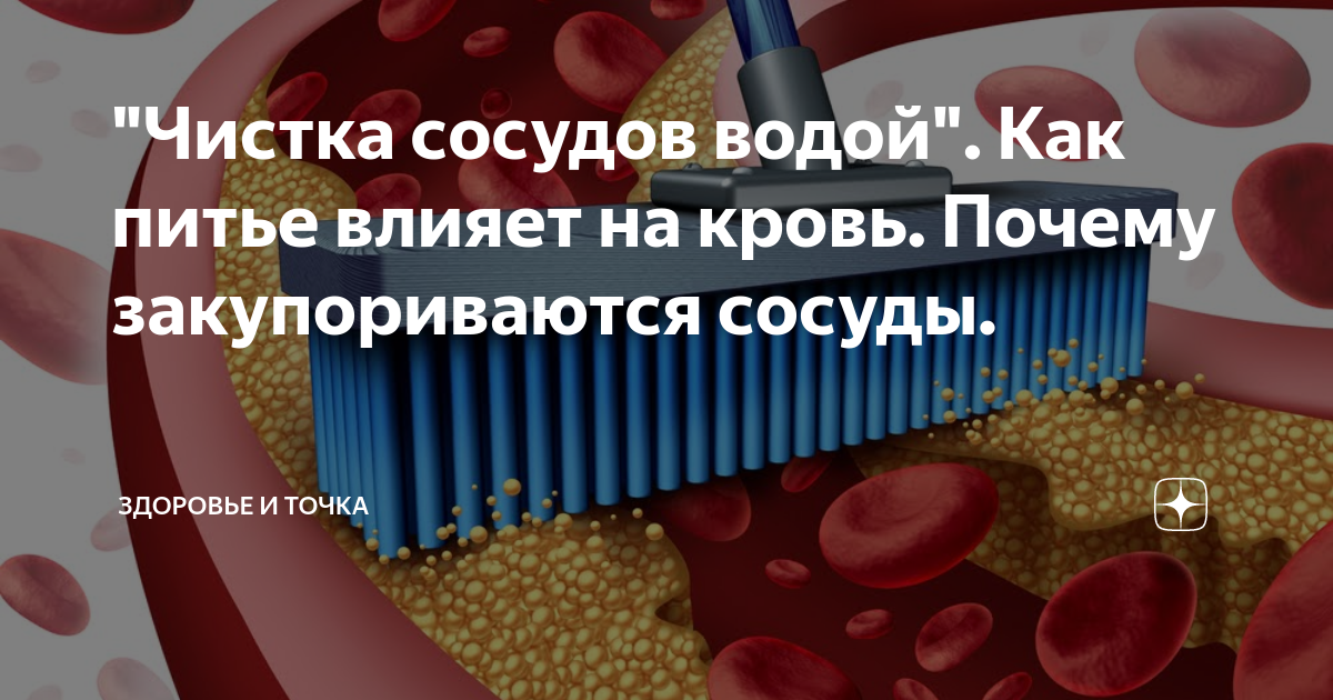 Как очистить сосуды от холестерина. Продукты для чистки сосудов. Очистка сосудов от атеросклеротических бляшек. Операция по очистке сосудов от холестериновых бляшек.