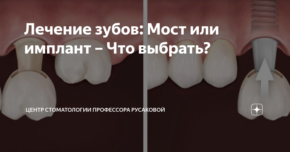 Лечение зубов: Мост или имплант – Что выбрать? | Центр стоматологии ...