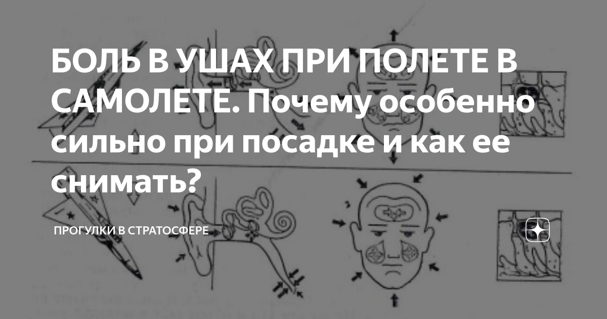 Заложило ухо после самолета. Почему болят уши при посадке самолета. Боль в ушах при посадке самолета. Сильная боль в ушах при посадке самолета. Сильная боль в ухе при посадке в самолете.