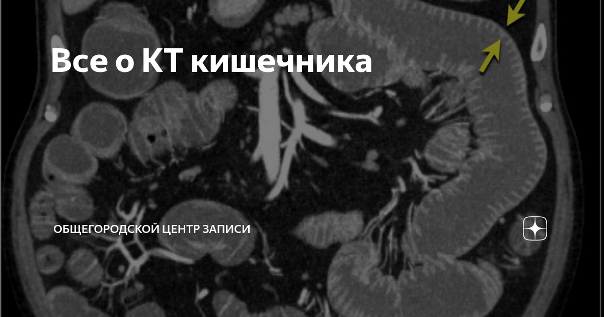 Лимфома Толстого кишечника кт. Отделы тонкого кишечника кт. Опухоль тонкой кишки на кт.