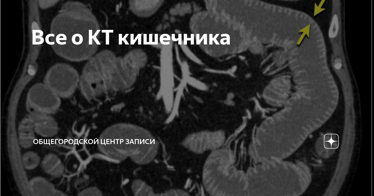 Кт кишечника. Лимфома Толстого кишечника кт. Отделы тонкого кишечника кт. Опухоль тонкой кишки на кт.