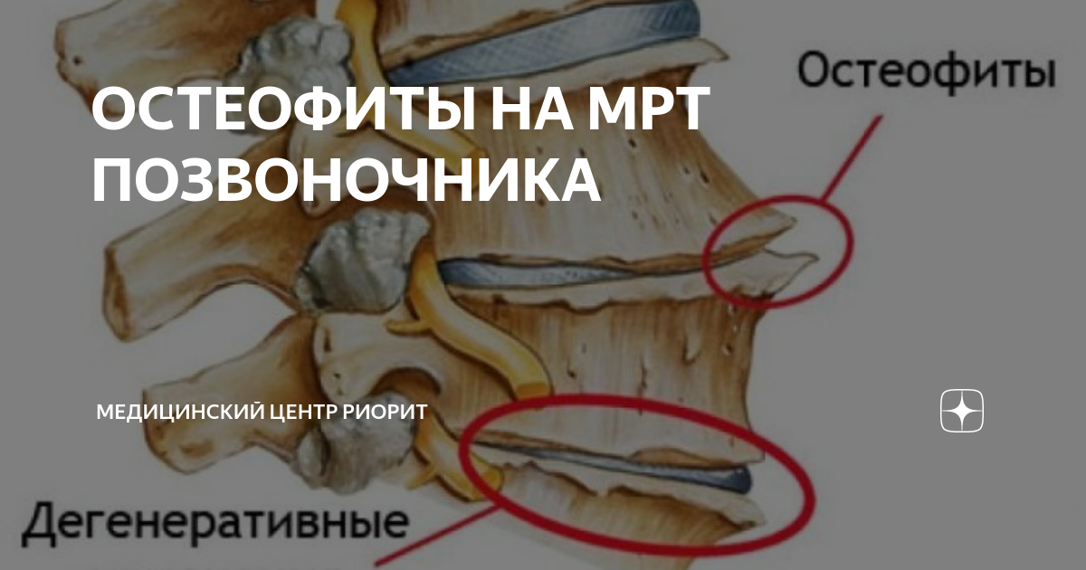 Что такое остеофиты