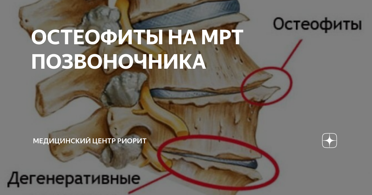 Задние остеофиты позвонков. Остеофиты l3-l5. Вентральные остеофиты. Боковые остеофиты позвоночника. Дорсальные остеофиты.