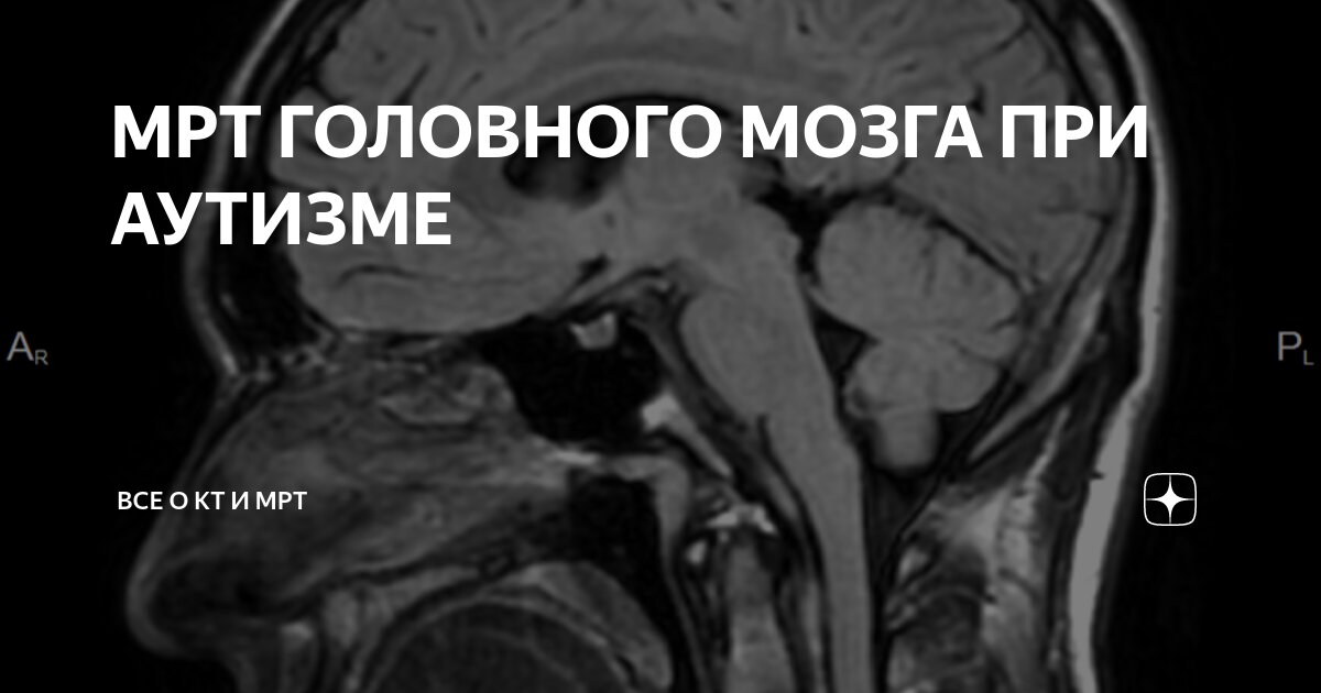 Мрт при аутизме. Мрт аутистов. Мрт головного мозга аутизм. Аутизм на мрт мозга.