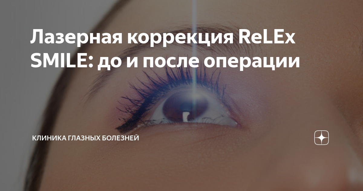 Лазерная коррекция ReLEx SMILE: до и после операции | Клиника глазных ...