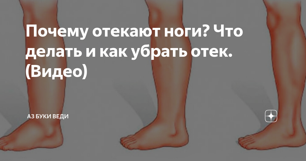 Отеки причины у женщин после 30. Отеки нижних конечностей.