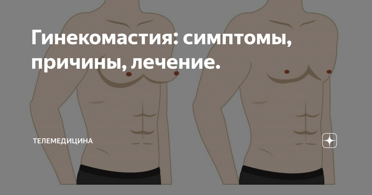 Гинекомастия у мужчин код по мкб 10. Пубертатная гинекомастия. Лекарства от гинекомастии.