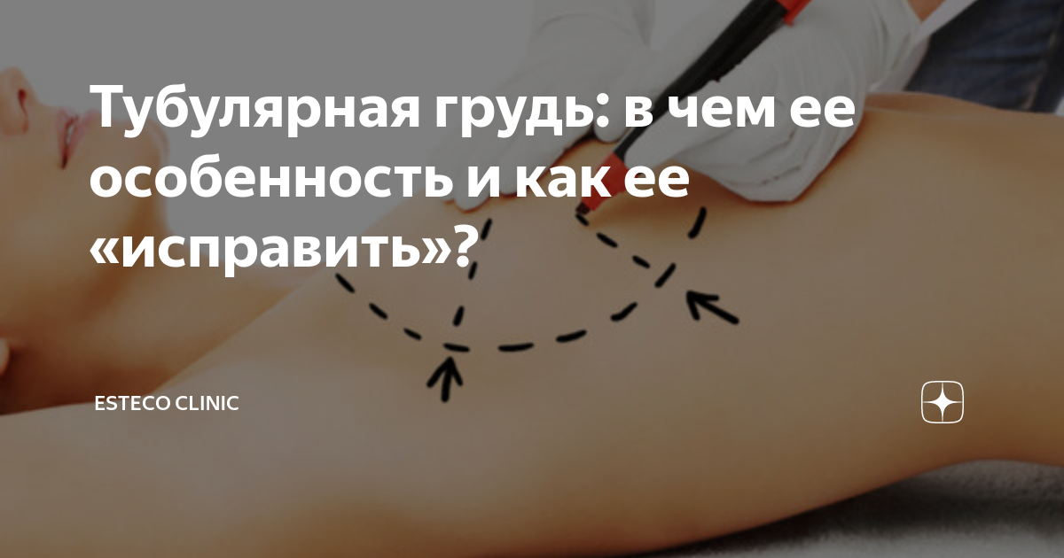 Тубулярная форма молочных желез. Тубулярная деформация молочных желез. Тубулярная деформация молочных желез у женщин. Тубулярная форма молочной железы. Коррекция тубулярной деформации молочных желез.