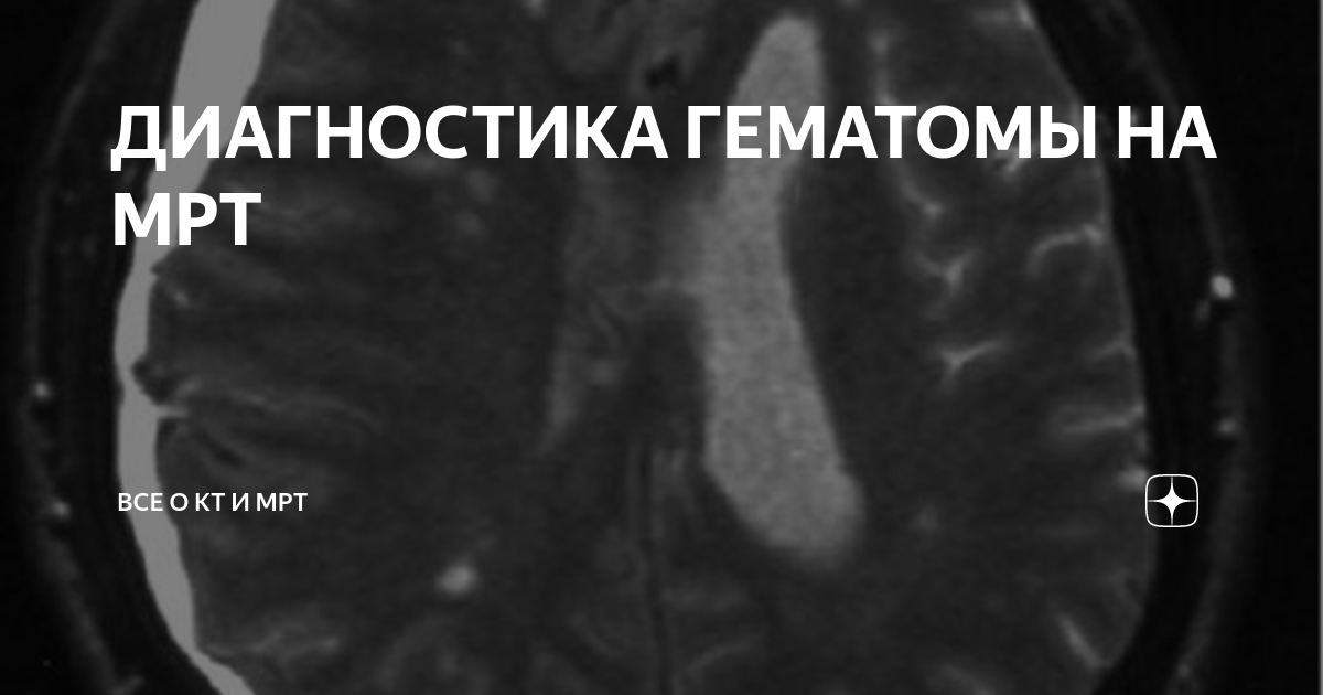 ДИАГНОСТИКА ГЕМАТОМЫ НА МРТ | Все о КТ и МРТ | Дзен
