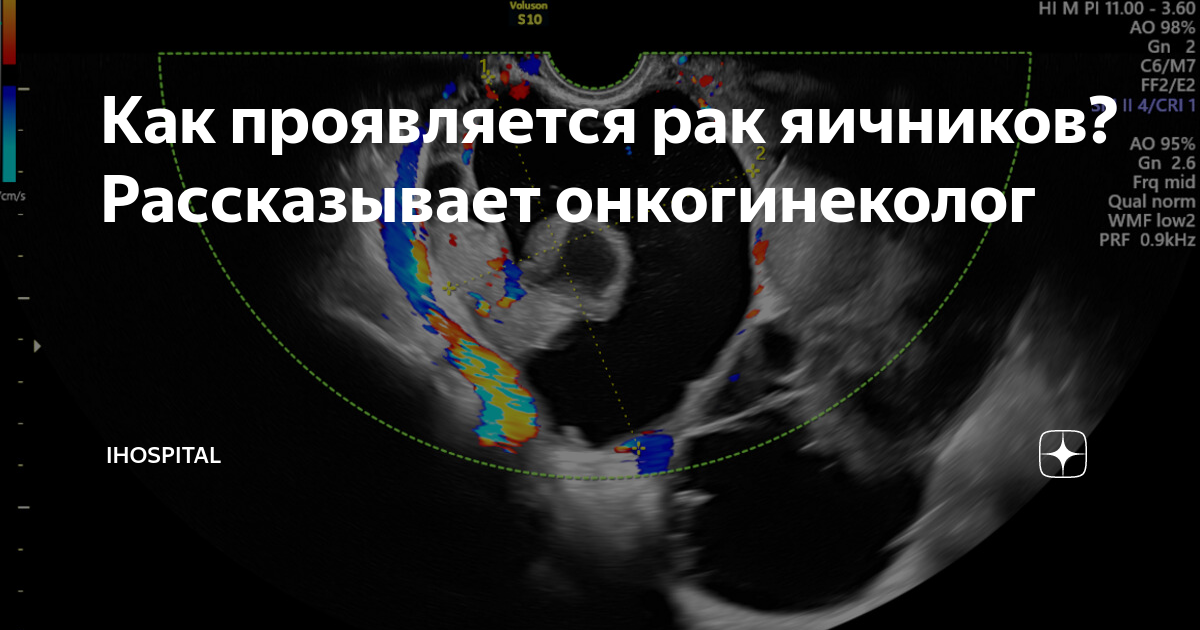 Как проявляется рак яичников? Рассказывает онкогинеколог | Ильинская ...