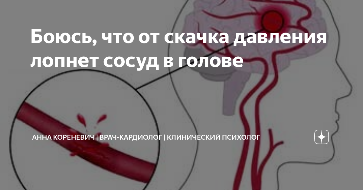 Боюсь, что от скачка давления лопнет сосуд в голове | Анна Кореневич ...